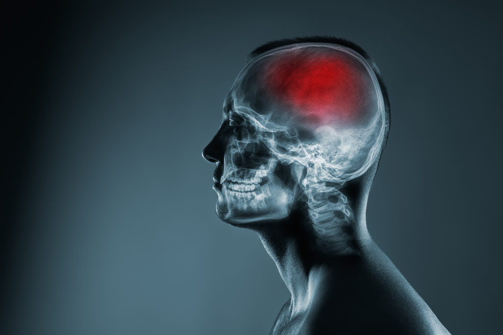 Philadelphia Failure to Diagnose Stroke Lawyer